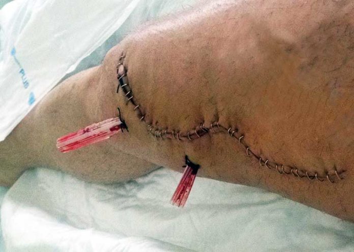 Impactante imagen del muslo derecho partido del sevillano Curro Durán.
